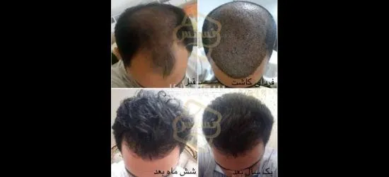 زراعة الشعر عالية الجودة