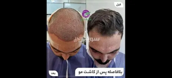 زراعة الشعر عالية الجودة - 3