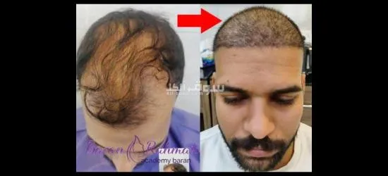 زراعة الشعر - 3